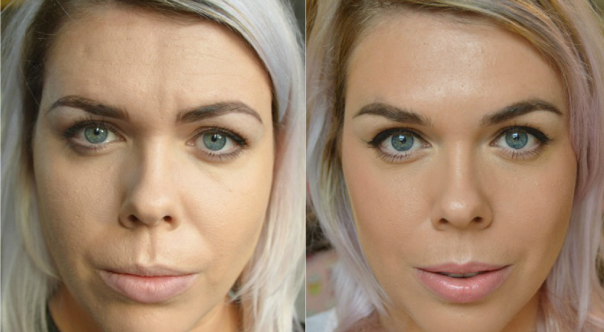 Botox prije i poslije (1)