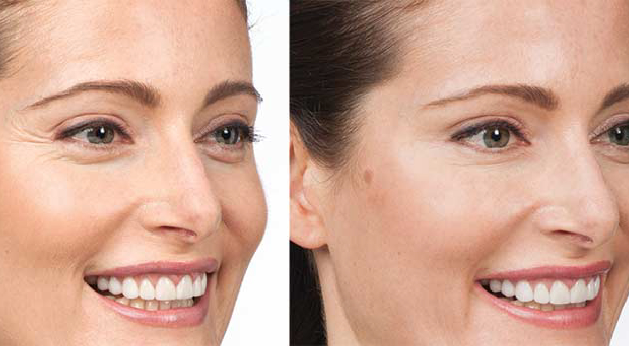Botox prije i poslije (4)