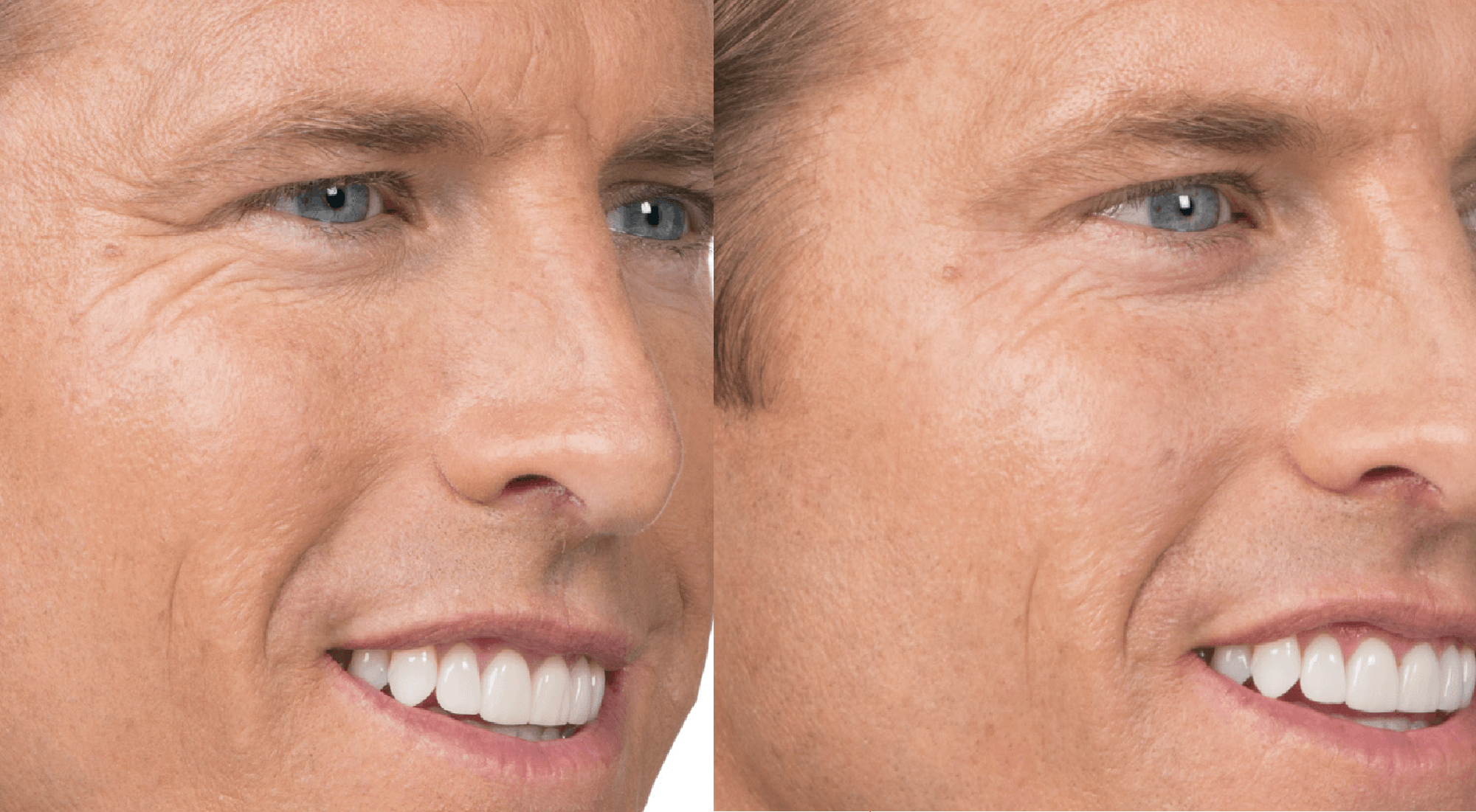 Botox prije i poslije (5)