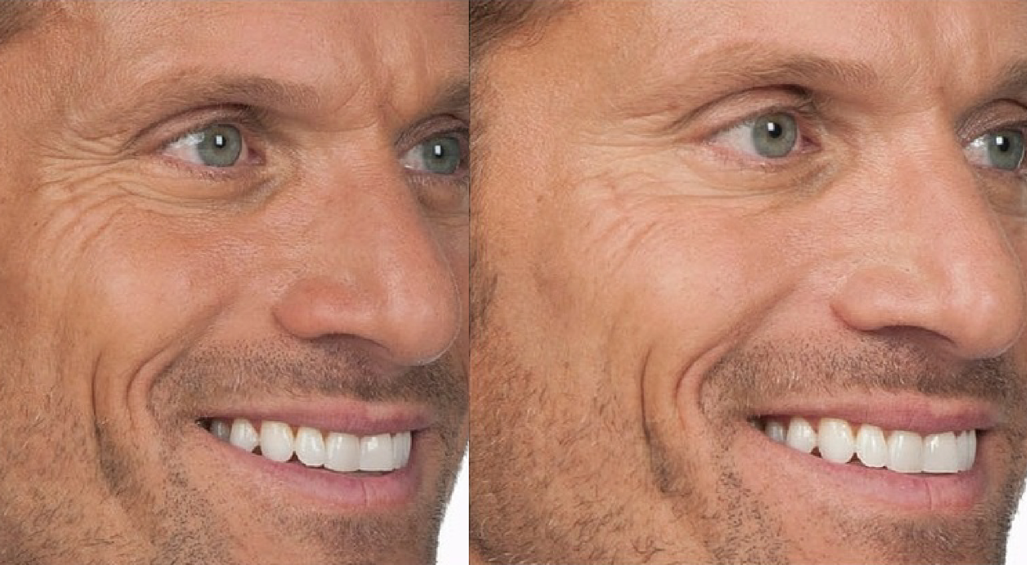 Botox prije i poslije (6)