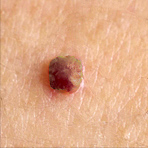 fibroma_2