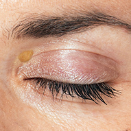 xantelasma